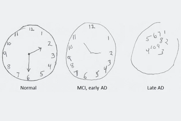 Evaluación cognitiva con el test del reloj cómo hacerlo