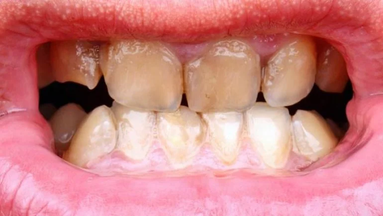 Causas y soluciones rápidas para dientes marrones
