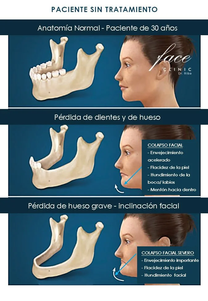 Pérdida dental causas y soluciones
