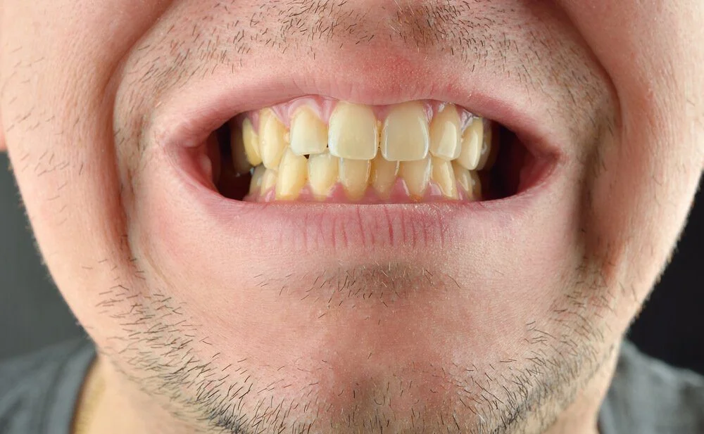 Dientes nuevos amarillos causas y soluciones