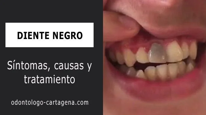 Causas y tratamiento de la muela negra interna