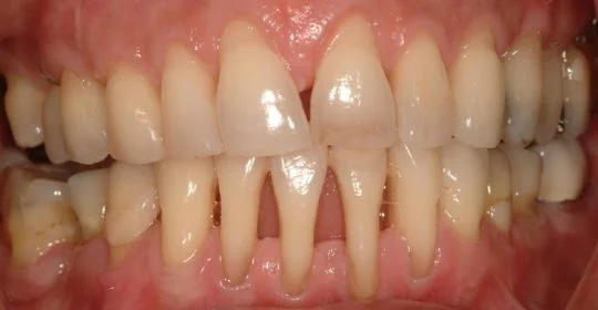 Dientes inferiores moviéndose ¿por qué?