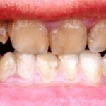 Causas y soluciones rápidas para dientes marrones