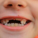 La dentición en niños etapa de los colmillos caídos