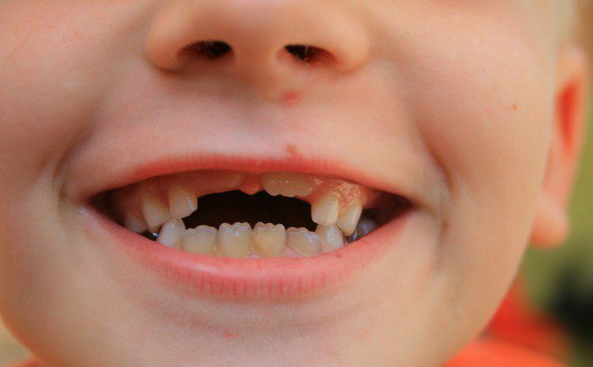 La dentición en niños etapa de los colmillos caídos
