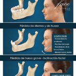Pérdida dental causas y soluciones