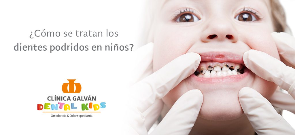 Prevención y tratamiento de dientes podridos en niños