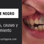 Causas y tratamiento de la muela negra interna