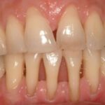 Dientes inferiores moviéndose ¿por qué?