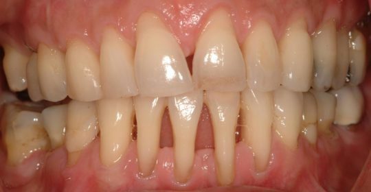 Dientes inferiores moviéndose ¿por qué?