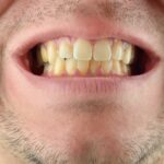 Dientes nuevos amarillos causas y soluciones