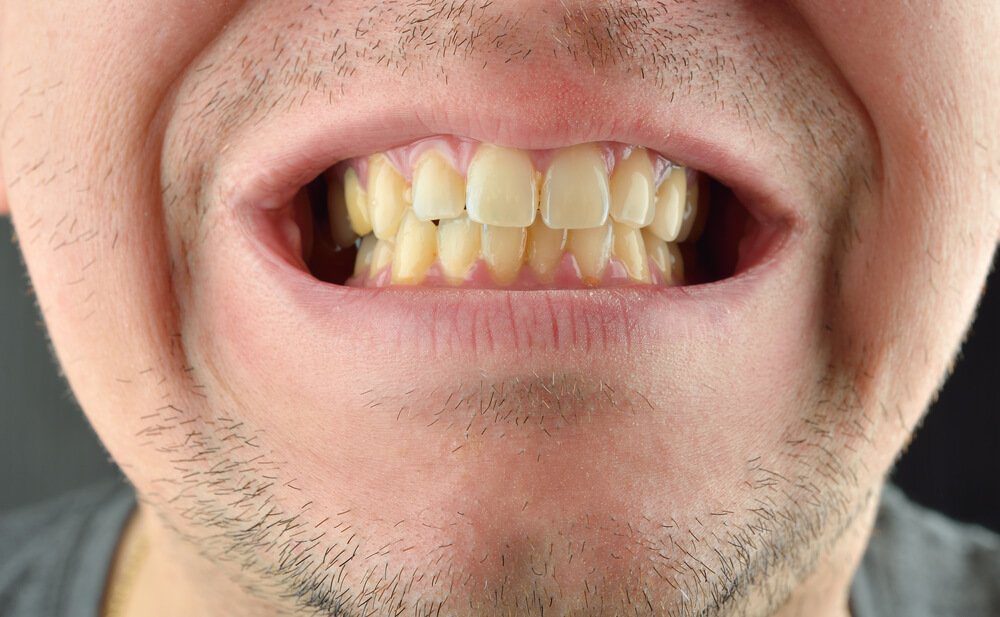 Dientes nuevos amarillos causas y soluciones