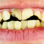 Relación entre drogas y pérdida dental ¿Por qué se caen?